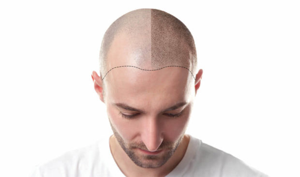 3 Reasons Why Hair Transplants In Turkey Are The Ultimate Experience