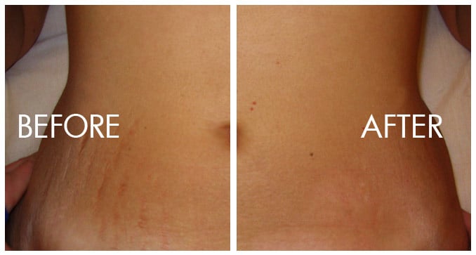 Stretch Marks And How To Treat Them -