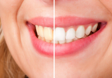 Why Visit a Cosmetic Dentist? - whitening, tooth, smile, Cosmetic Dentist