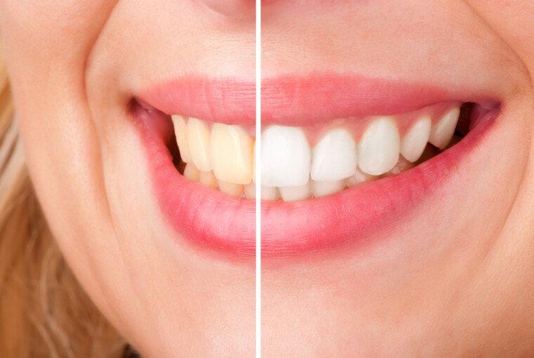 Why Visit a Cosmetic Dentist? - whitening, tooth, smile, Cosmetic Dentist