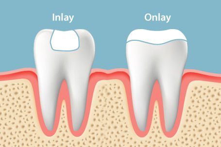 Comprehensive Procedure Guide for Inlays - inalays, dental care, dental