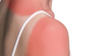 5 Simple Tips That Will Save Your Skin After Your Summer Vacation