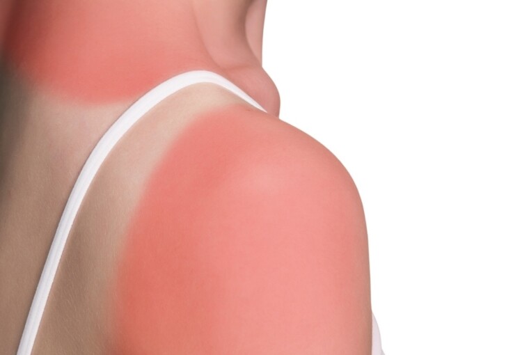 5 Simple Tips That Will Save Your Skin After Your Summer Vacation 5 Simple Tips That Will Save Your Skin After Your Summer Vacation - sun, skincare, skin care, skin, protection, products, oil, lotion, hydration, cream, care, body oil