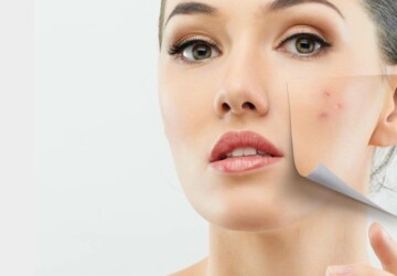 THE SKIN BEFORE AND AFTER ACNE REMOVAL BY THE EXPERTS - treatments, skin, removal, products, natural treatment, hormones, healthy food, experts, acne