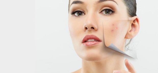 THE SKIN BEFORE AND AFTER ACNE REMOVAL BY THE EXPERTS - treatments, skin, removal, products, natural treatment, hormones, healthy food, experts, acne