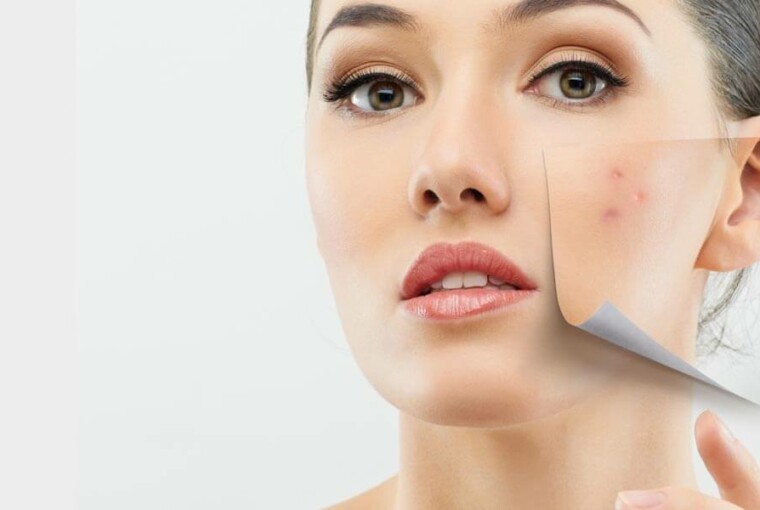 THE SKIN BEFORE AND AFTER ACNE REMOVAL BY THE EXPERTS - treatments, skin, removal, products, natural treatment, hormones, healthy food, experts, acne