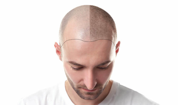 3 Reasons Why Hair Transplants In Turkey Are The Ultimate Experience - transplants, traditional, tourism, istanbul, Hair, experience