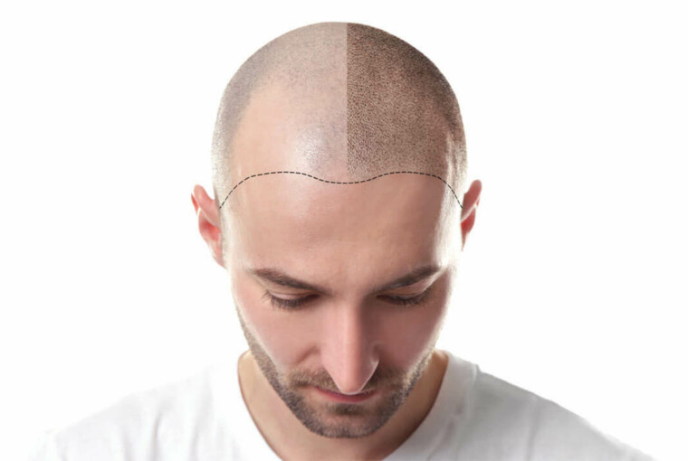 3 Reasons Why Hair Transplants In Turkey Are The Ultimate Experience - transplants, traditional, tourism, istanbul, Hair, experience