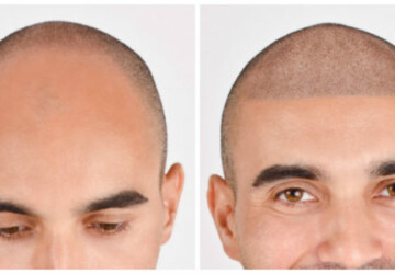 Should You Get A Scalp Micropigmentation? 5 Reasons To Think About It - tips, scalp, micropigmentation