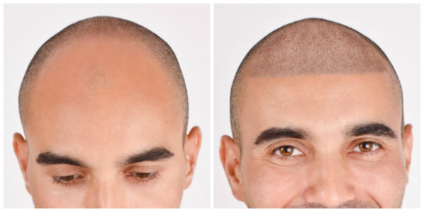 Should You Get A Scalp Micropigmentation? 5 Reasons To Think About It - tips, scalp, micropigmentation