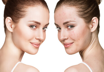 Skin Purging Versus Breakouts: All You Need to Know - woman, Skin purging, skin, fashion, care