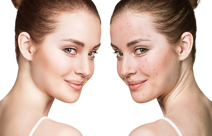 Skin Purging Versus Breakouts: All You Need to Know - woman, Skin purging, skin, fashion, care