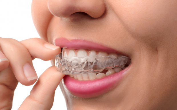 Invisalign Benefits & The Process - teeth, orthodontist, invisalign, dental