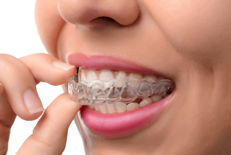 Invisalign Benefits & The Process Invisalign Benefits & The Process - teeth, orthodontist, invisalign, dental