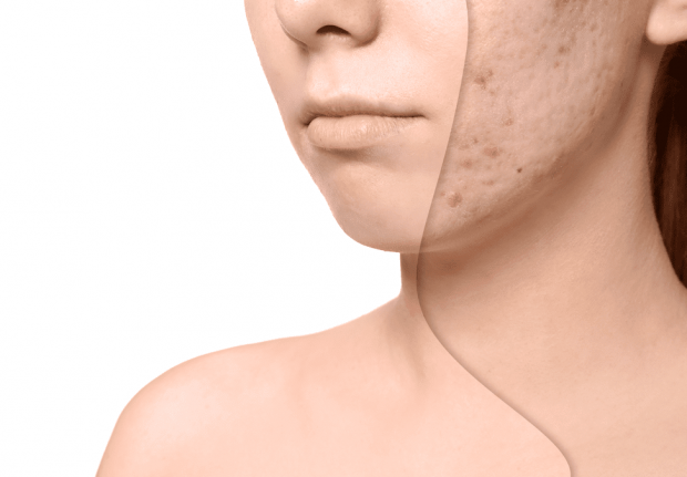The Best Acne Scar Removal Therapy - removal, laser skin, dermal fillers, acne scar