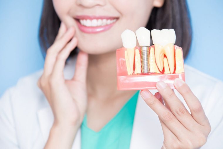 When Should You Opt for Dental Implants? When Should You Opt for Dental Implants? - health, dental, beauty