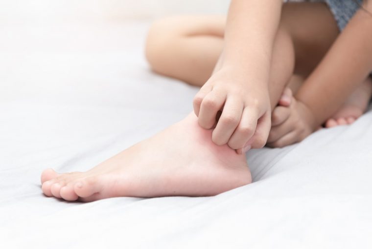 The Unfavourable Health Risks Of Bed Bug Infestations The Unfavourable Health Risks Of Bed Bug Infestations - sleep quality, skin infections, health risk, bed bug