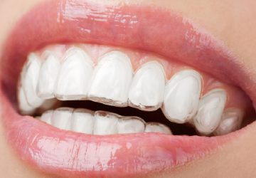 How Can Invisalign Change Your Life? - teeth, dental, confident with your smile, braces