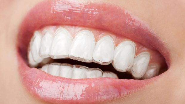 How Can Invisalign Change Your Life? - teeth, dental, confident with your smile, braces