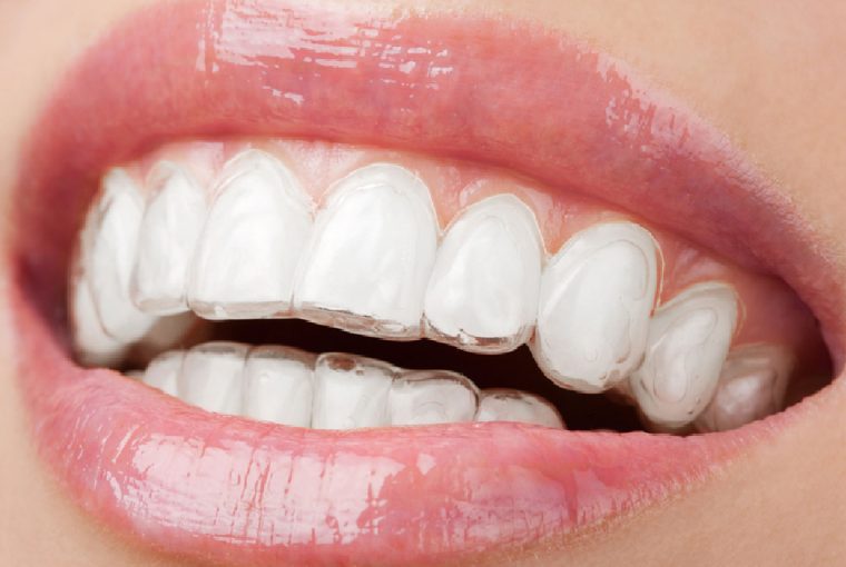 How Can Invisalign Change Your Life? - teeth, dental, confident with your smile, braces