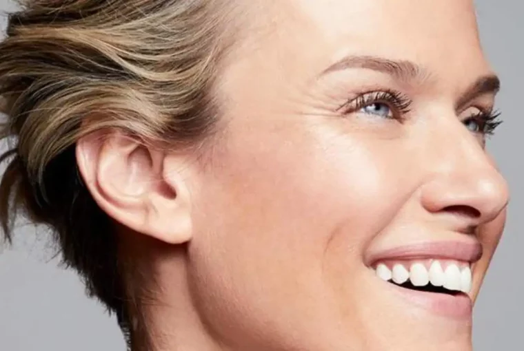 How to Get Rid of Crow's Feet? How to Get Rid of Crow's Feet? - moisturize, face, exercise, dermal fillers, crow's feet, botox